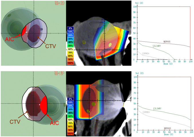 Impact of Ocular Proton Therapy on Corneal Subbasal Nerve Plexus in Uveal Melanoma: Longitudinal Confocal Microscopy Findings