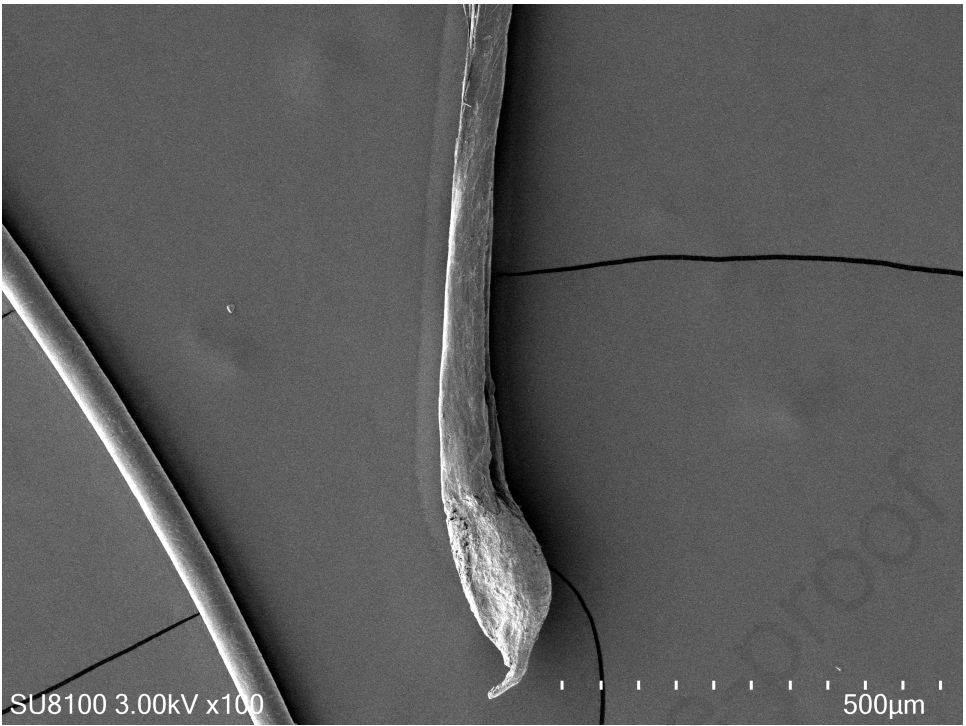 Acquired Hair Texture Alteration After Regrowth in Alopecia Areata: A Distinct Clinical and Ultrastructural Phenotype